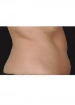 CoolSculpting Fat Reduction  Case #12696 - The Skin Center